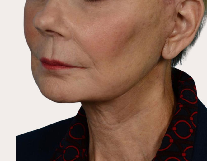 neck lift after picture